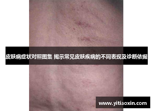 皮肤病症状对照图集 揭示常见皮肤疾病的不同表现及诊断依据